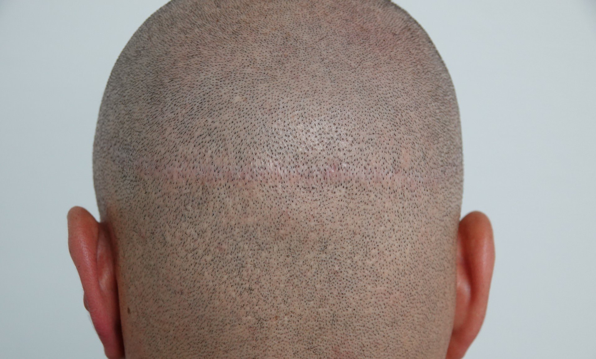 Zu sehen sind wieder wachsende Haare auf einer FUT-Narbe auf dem Hinterkopf eines Patienten.