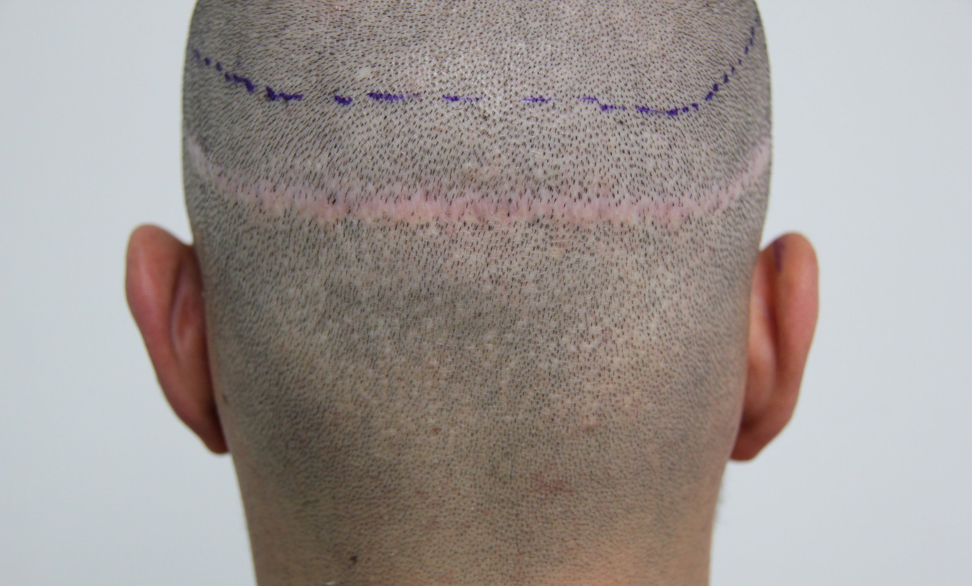 Der Hinterkopf eines Mannes mit einer sehr auffälligen Stripnarbe.
